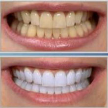 خرید بهترین پکیج سفید کننده دندان | رفع زردی دندان با پکیج سفید کننده | زیبا کردن دندان ها