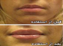 حجم دهنده لب تاچ می